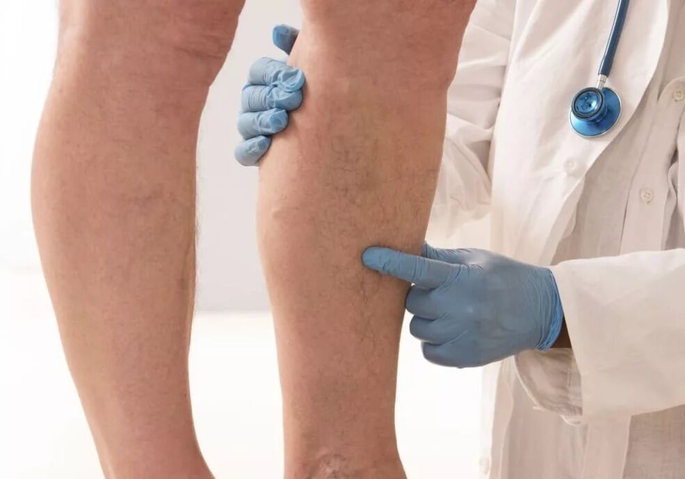 The doctor examines the leg with varicose veins