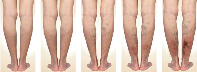 stage of development of varicose veins