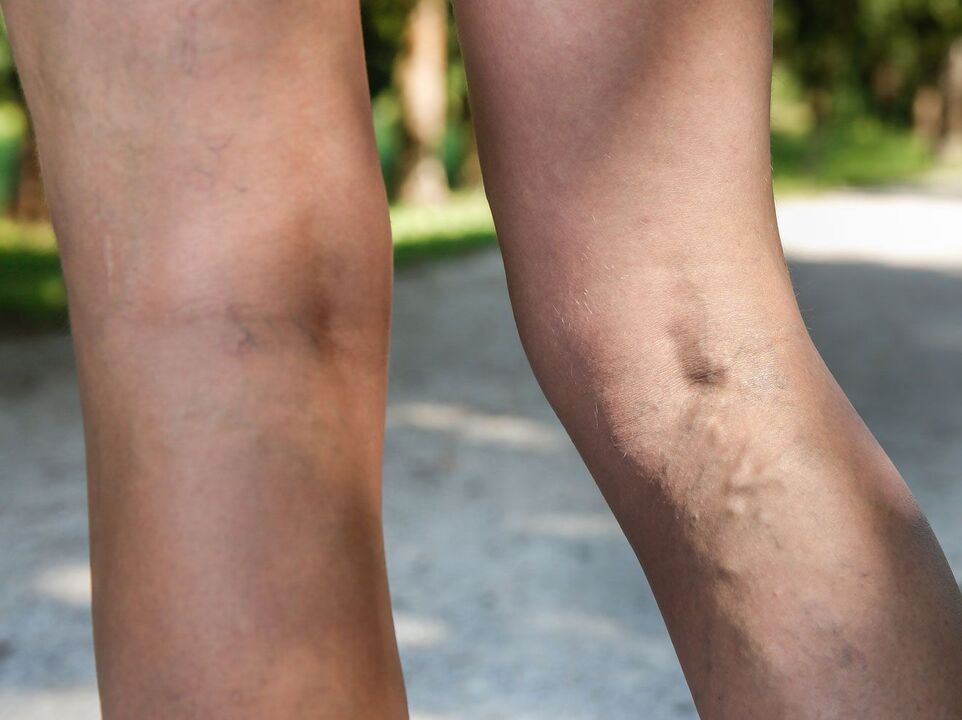 varicose veins on the legs