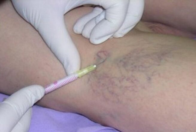 injections for varicose veins