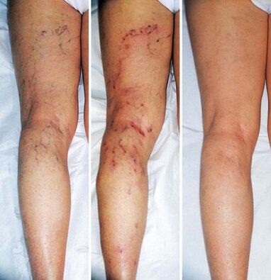 Lower limb before and after varicose vein treatment