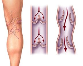 Normal valve operation in healthy veins and valve pathology in varicose veins