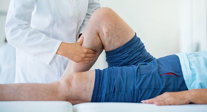 advanced stages of varicose veins