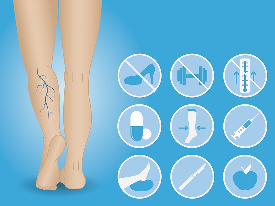 Varicose veins on the lower leg