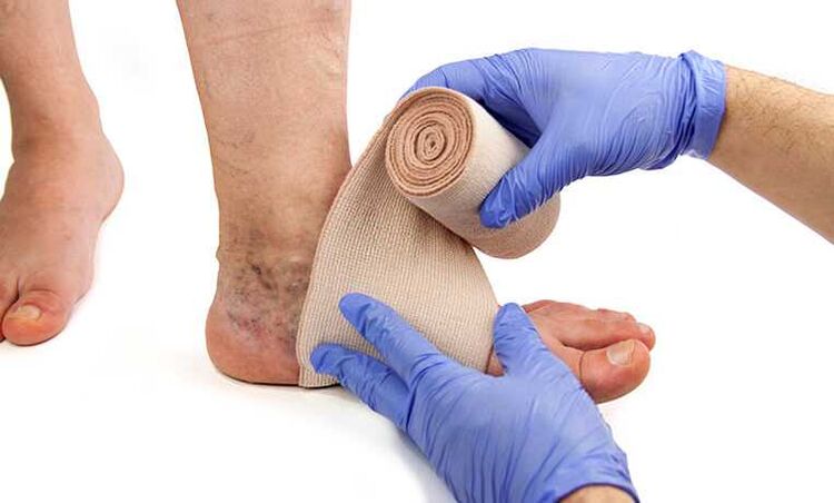 The treatment of varicose veins on the legs is complemented by the use of compression stockings