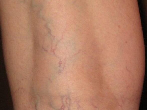 Varicose veins