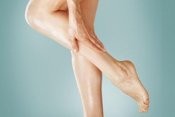 varicose veins
