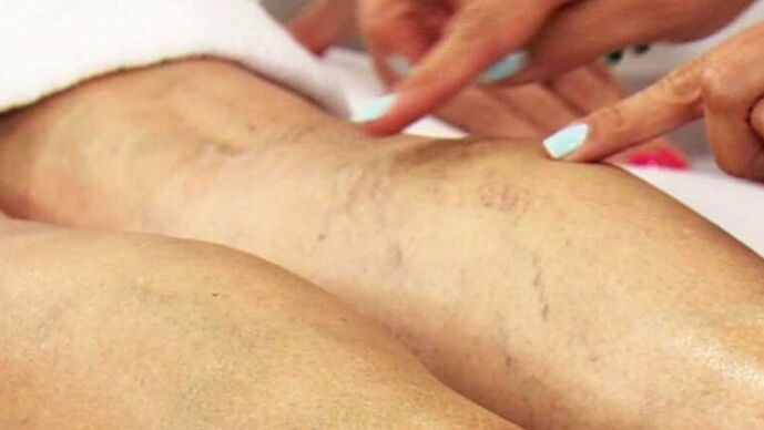 Varicose veins from the lower leg