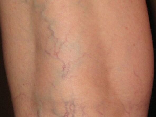 Varicose vein stage
