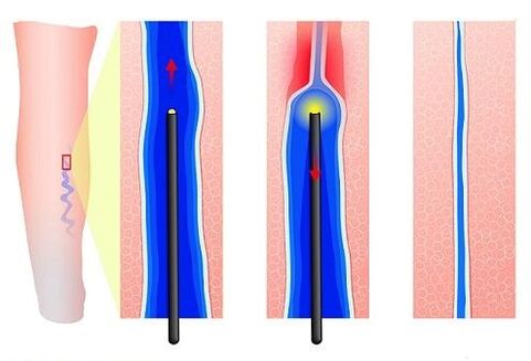 Freezing of laser