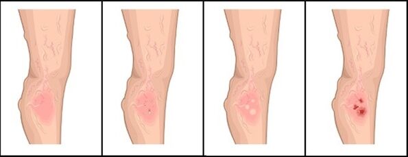 The level of varicose veins