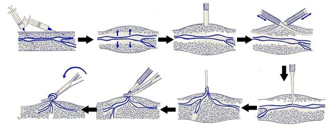 Varadi's operation
