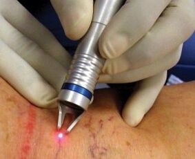 How laser treatment for varicose veins is performed