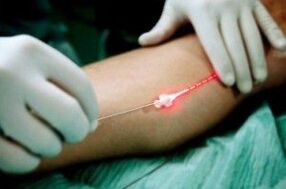 Laser treatment against varicose veins in the legs