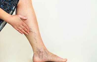 How to treat varicose veins from lower lower leg