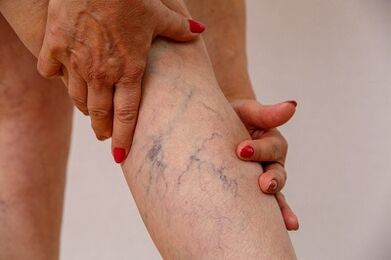 varicose veins from the lower leg