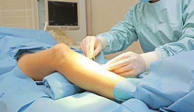 For what are the symptoms of surgery for varicose veins prescribed