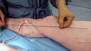 How surgery is performed for varicose veins