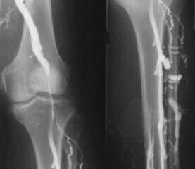 Diagnostic options for varicose veins from the legs