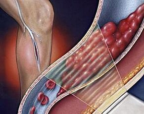 varicose veins from the deep veins of the lower legs