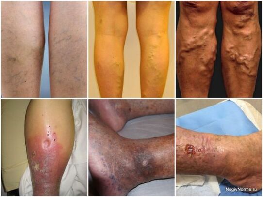 The degree of damage to the varicose veins