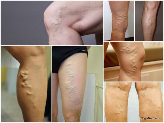 What is the varicose vein