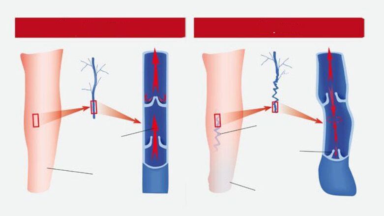 What varicose veins are like