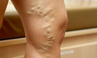 The signs and symptoms of varicose veins in the feet